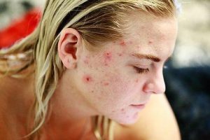 How Can CBD Help You To Get Rid Of Acne