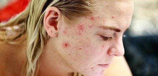 How Can CBD Help You To Get Rid Of Acne